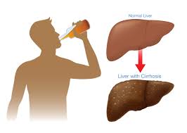ALCOHOLIC LIVER DISEASES