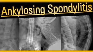 ANKYLOSING SPONDYLITIS