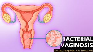BACTERIAL VAGINOSIS