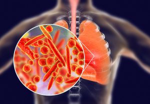 PNEUMONIA