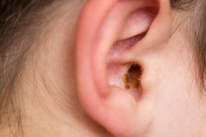 CAUSES OF EARWAX BLOCKAGE