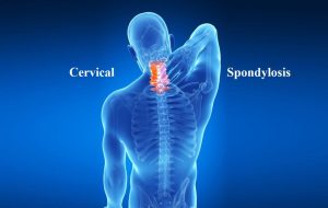 CERVICAL SPONDYLOSIS