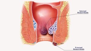 PREVENTION OF HEMORRHOIDS