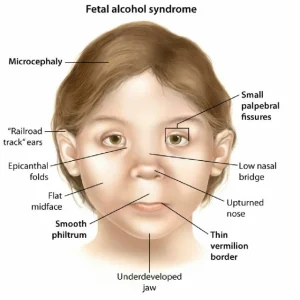 FETAL ALCOHOL SYNDROME