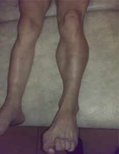 POST POLIO SYNDROME
