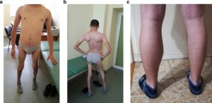 LIMB-GIRDLE DYSTROPHY