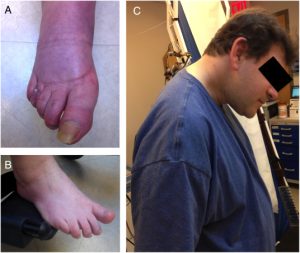 SIGNS OF MULTIPLE SYSTEM ATROPHY