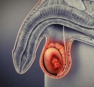 TESTICULAR CANCER