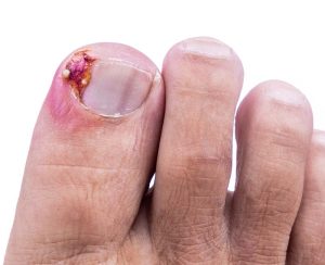 INGROWN TOENAILS