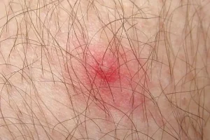 PREVENTION OF TICK BITES