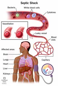 CAUSES OF SEPTIC SHOCK