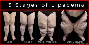 LIPEDEMA