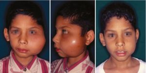 TYPES OF RHABDOMYOSARCOMA