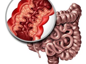 INFLAMMATORY BOWEL DISEASE