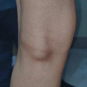 BAKER CYSTS