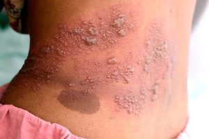 SIGNS OF SHINGLES