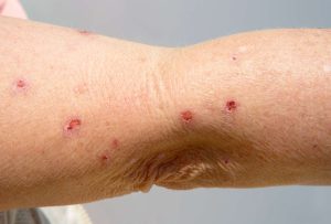SIGNS OF PHOTOSENSITIVITY