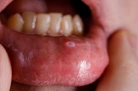 Mucocele