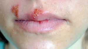 upper lip Infection