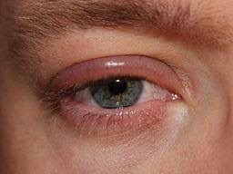 Eyelid infection