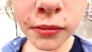 TYPES OF IMPETIGO