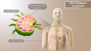 NON-HODGKIN LYMPHOMA