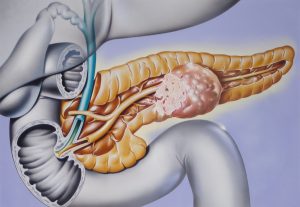 NEUROENDOCRINE TUMORS