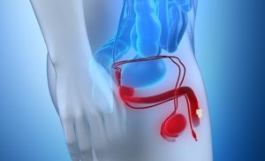 PENILE CANCER