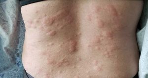 CAUSES OF HIVES