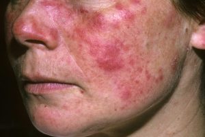 LUPUS