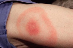 LYME DISEASE