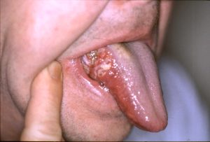 ORAL CANCER