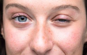 MYASTHENIA GRAVIS