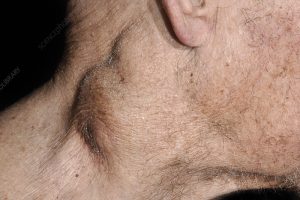 SYMPTOMS OF HODGKIN LYMPHOMA