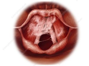 CAUSES OF LARYNGITIS