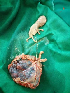 MOLAR PREGNANCY