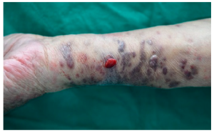 KAPOSI SARCOMA
