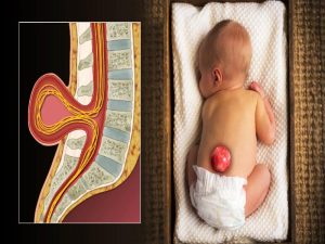CAUSES OF SPINA BIFIDA
