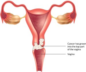 VAGINAL CANCER