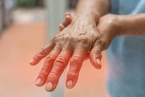 PERIPHERAL NEUROPATHY