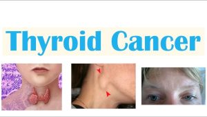 TREATMENT OF THYROID CANCER