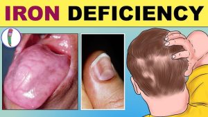 SIGNS OF IRON DEFICIENCY ANEMIA