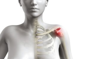SHOULDER IMPINGEMENT