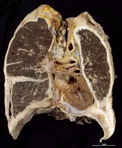 MESOTHELIOMA