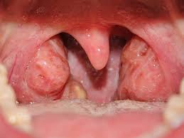 PREVENTION OF TONSILLITIS