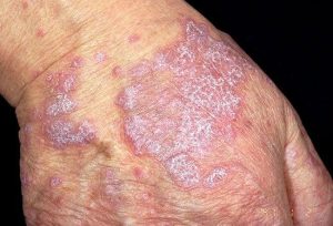 LICHEN PLANUS