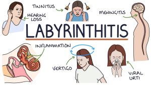 LABYRINTHITIS