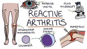 REACTIVE ARTHRITIS