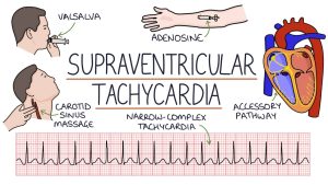 SUPRAVENTRICULAR TACHYCARDIA