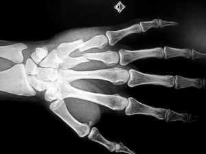 METACARPAL FRACTURES